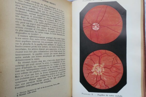 pathologie DIEULAFOY MANUEL DE PATHOLOGIE INTERNE 1918 – Image 7